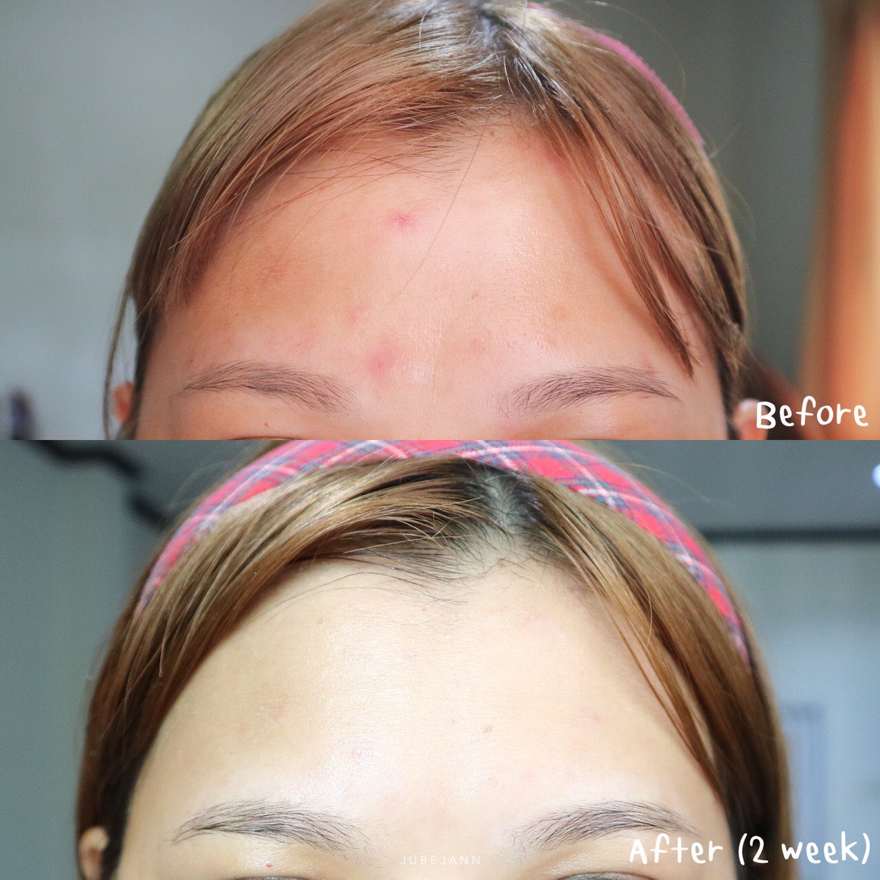 รีวิวจากผู้ใช้จริง Some By Mi Red Teatree Cicassoside Final Solution Serum